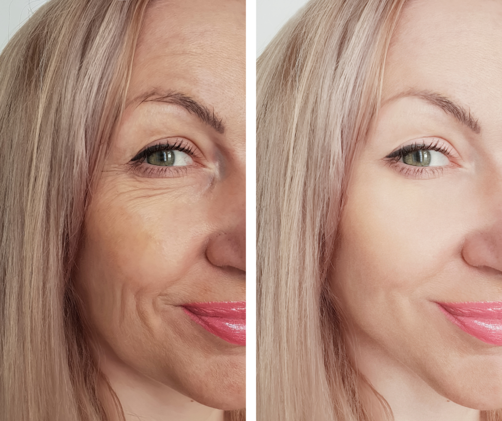 DIATERMIA TERAPIA RET diatermia efekt